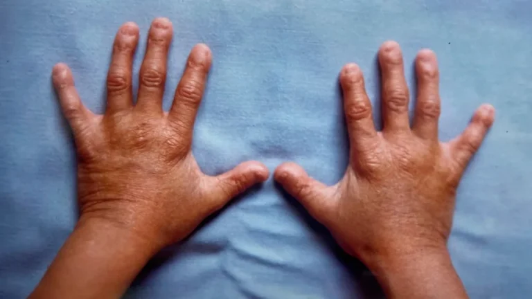 Benjamin Button Apos 25 anos estudo de caso sobre progeria ainda e referencia global
