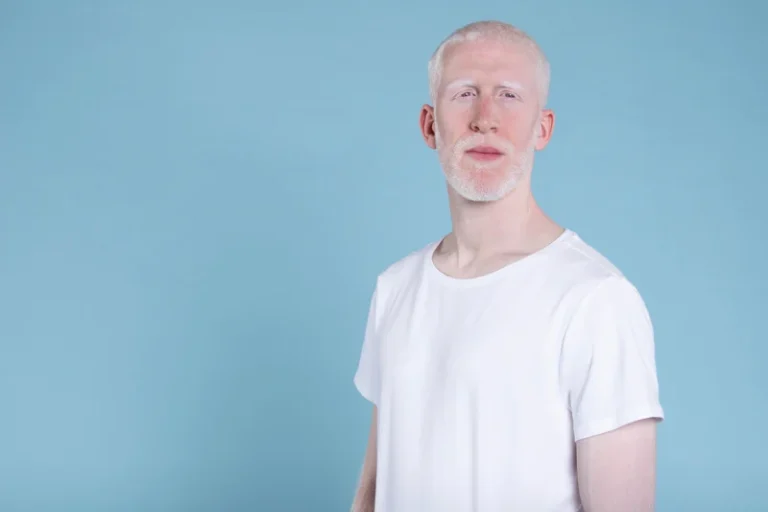 albino 30052025